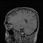 My Brain. Brain MRI Pictures.