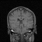 My Brain. Brain MRI Pictures.