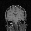 My Brain. Brain MRI Pictures.