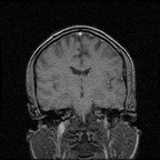 My Brain. Brain MRI Pictures.