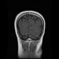 My Brain. Brain MRI Pictures.