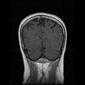 My Brain. Brain MRI Pictures.