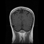 My Brain. Brain MRI Pictures.