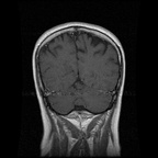 My Brain. Brain MRI Pictures.