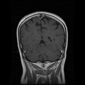 My Brain. Brain MRI Pictures.