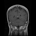 My Brain. Brain MRI Pictures.