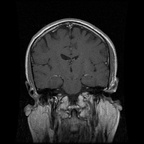 My Brain. Brain MRI Pictures.