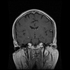 My Brain. Brain MRI Pictures.