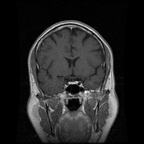 My Brain. Brain MRI Pictures.