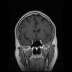 My Brain. Brain MRI Pictures.