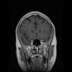 My Brain. Brain MRI Pictures.