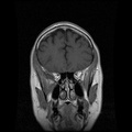 My Brain. Brain MRI Pictures.