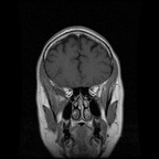 My Brain. Brain MRI Pictures.