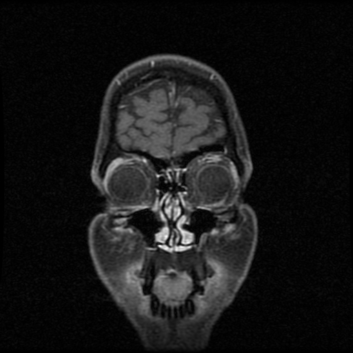 My Brain. Brain MRI Pictures.