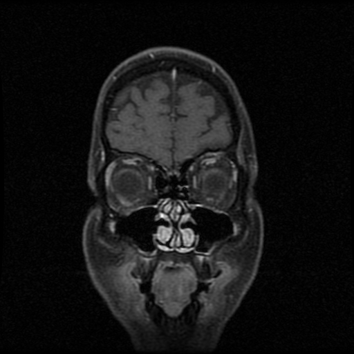 My Brain. Brain MRI Pictures.