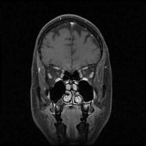 My Brain. Brain MRI Pictures.