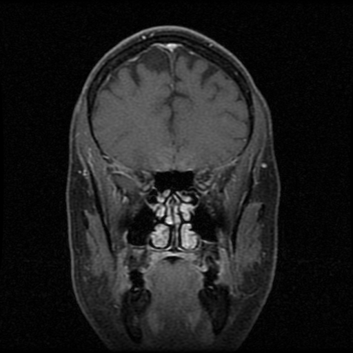 My Brain. Brain MRI Pictures.