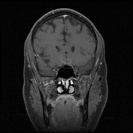 My Brain. Brain MRI Pictures.