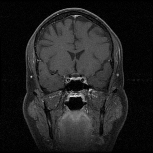 My Brain. Brain MRI Pictures.