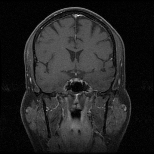 My Brain. Brain MRI Pictures.