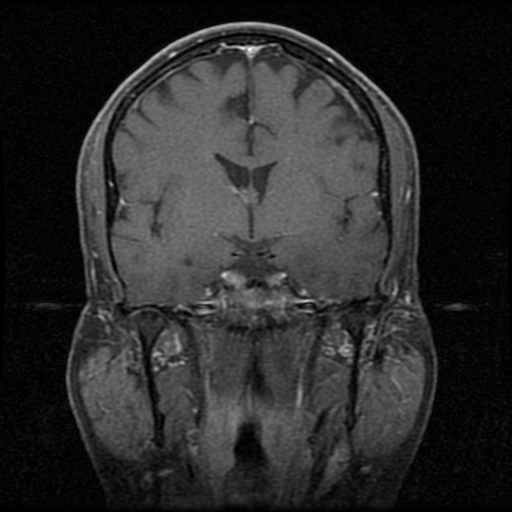 My Brain. Brain MRI Pictures.