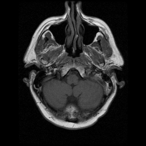 My Brain. Brain MRI Pictures.