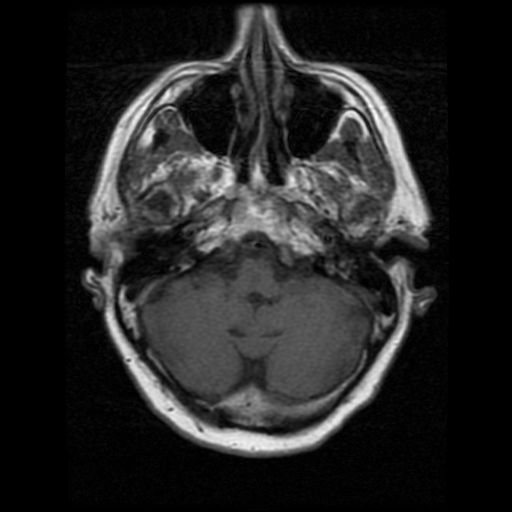 My Brain. Brain MRI Pictures.