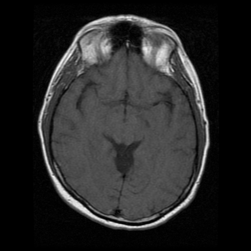 My Brain. Brain MRI Pictures.