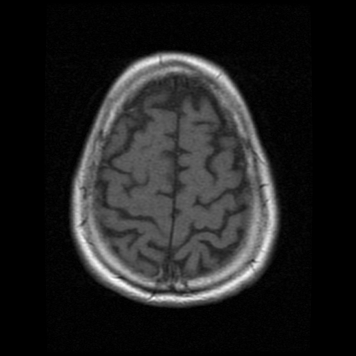 My Brain. Brain MRI Pictures.