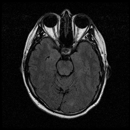 My Brain. Brain MRI Pictures.