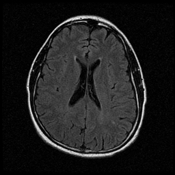 My Brain. Brain MRI Pictures.