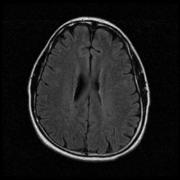 My Brain. Brain MRI Pictures.