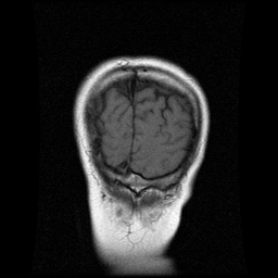 My Brain. Brain MRI Pictures.