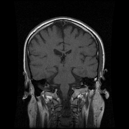 My Brain. Brain MRI Pictures.