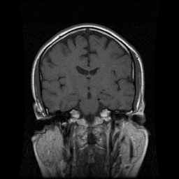 My Brain. Brain MRI Pictures.