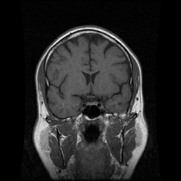 My Brain. Brain MRI Pictures.