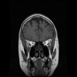 My Brain. Brain MRI Pictures.