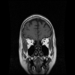 My Brain. Brain MRI Pictures.