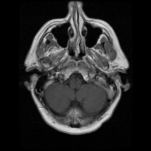 My Brain. Brain MRI Pictures.