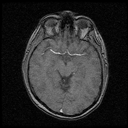 My Brain. Brain MRI Pictures.