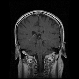 My Brain. Brain MRI Pictures.