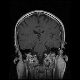 My Brain. Brain MRI Pictures.