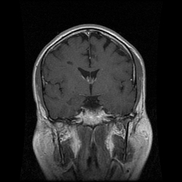 My Brain. Brain MRI Pictures.