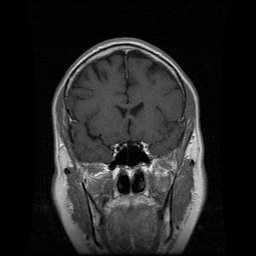 My Brain. Brain MRI Pictures.